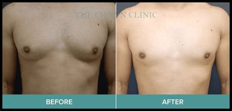 gynecomastia melbourne fl|6 Gynecomastia Surgery doctors in Melbourne, FL .
